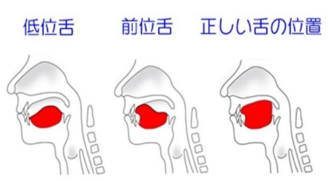 口腔筋機能療法