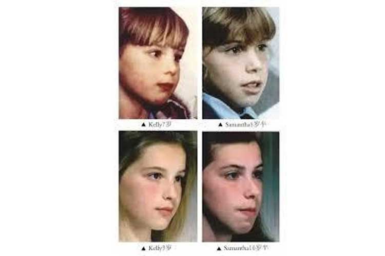 口腔筋機能療法