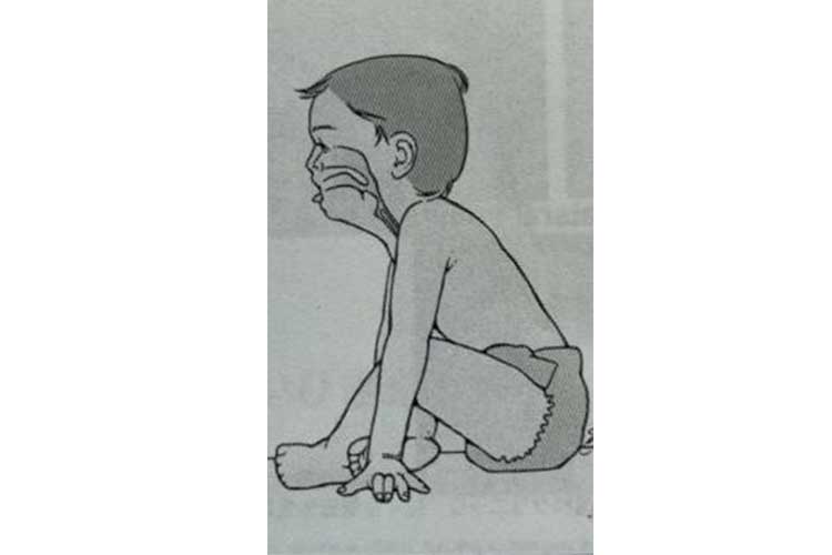 口腔筋機能療法