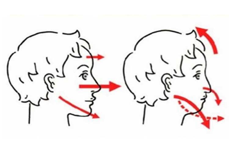 口腔筋機能療法